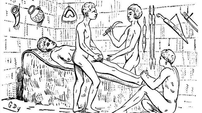 Auf der Zeichnung ist eine nackte hochschwangere Frau zu sehen, die auf einem Bett in einer Hütte liegt. Drei Männer stehen rundherum, einer hält den Bauch, der zweite die Füße, der dritte hält ein Messer in der Hand.   © Wikimedia 